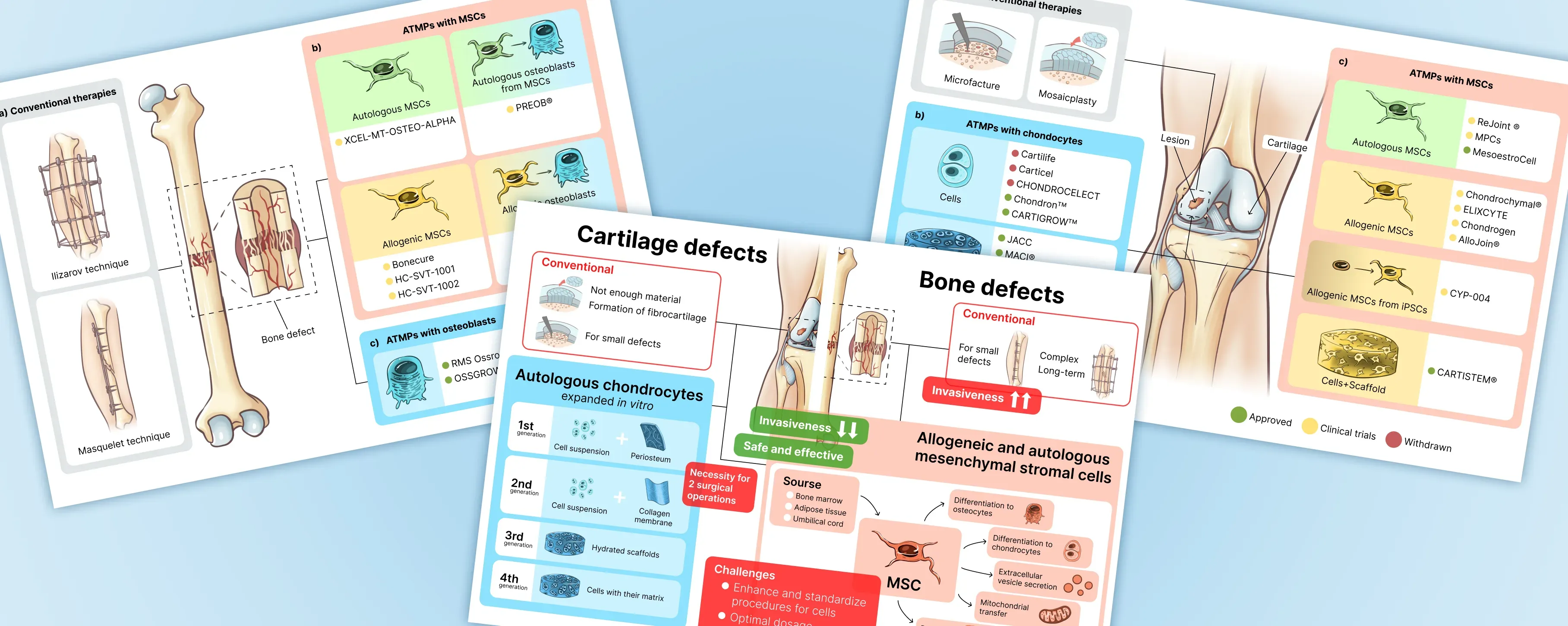 Advanced therapeutic medicinal products in bone and cartilage defects