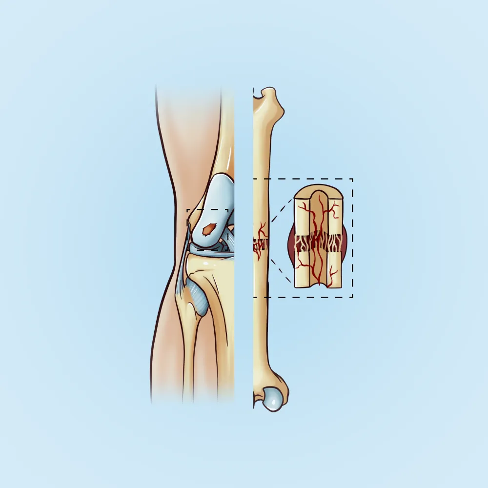 Иллюстрации для статьи Advanced therapeutic medicinal products in bone and cartilage defects